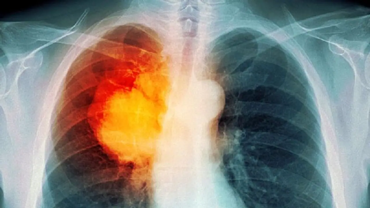 ശ്വാസകോശത്തിലെ ക്യാന്സര്; എന്തുകൊണ്ട് കണ്ടെത്താന് വൈകുന്നു? ശ്വാസകോശത്തിലെ ക്യാന്സര്; എന്തുകൊണ്ട് കണ്ടെത്താന് വൈകുന്നു?