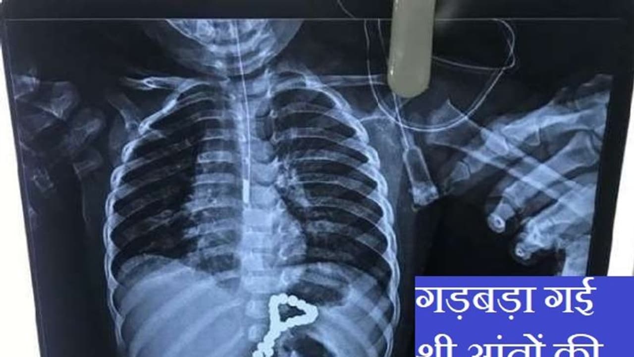 खेल खेल में 65 मोतियों की माला निगल गया डेढ़ साल का बच्चा, 5वें दिन रिपोर्ट देख हैरान हो गए डॉक्टर फिर.. खेल खेल में 65 मोतियों की माला निगल गया डेढ़ साल का बच्चा, 5वें दिन रिपोर्ट देख हैरान हो गए डॉक्टर फिर..