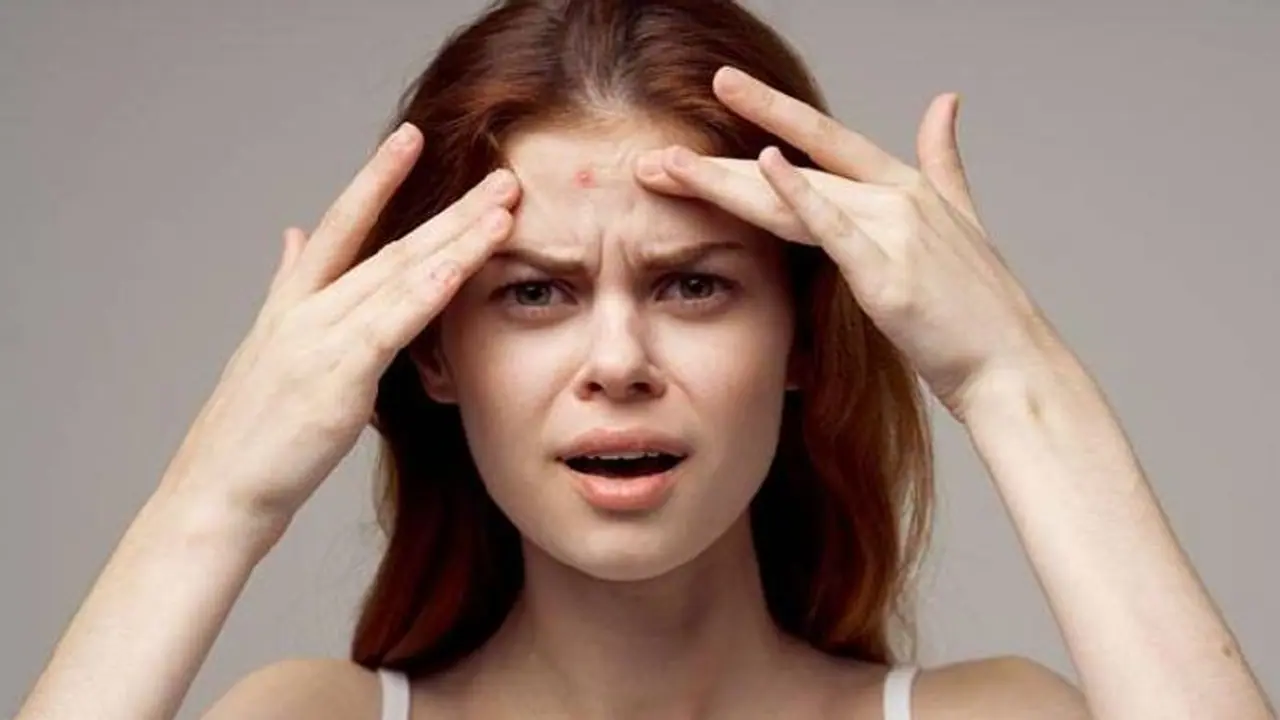 Tired of acne and pimple marks? Eat these foods to get rid of them