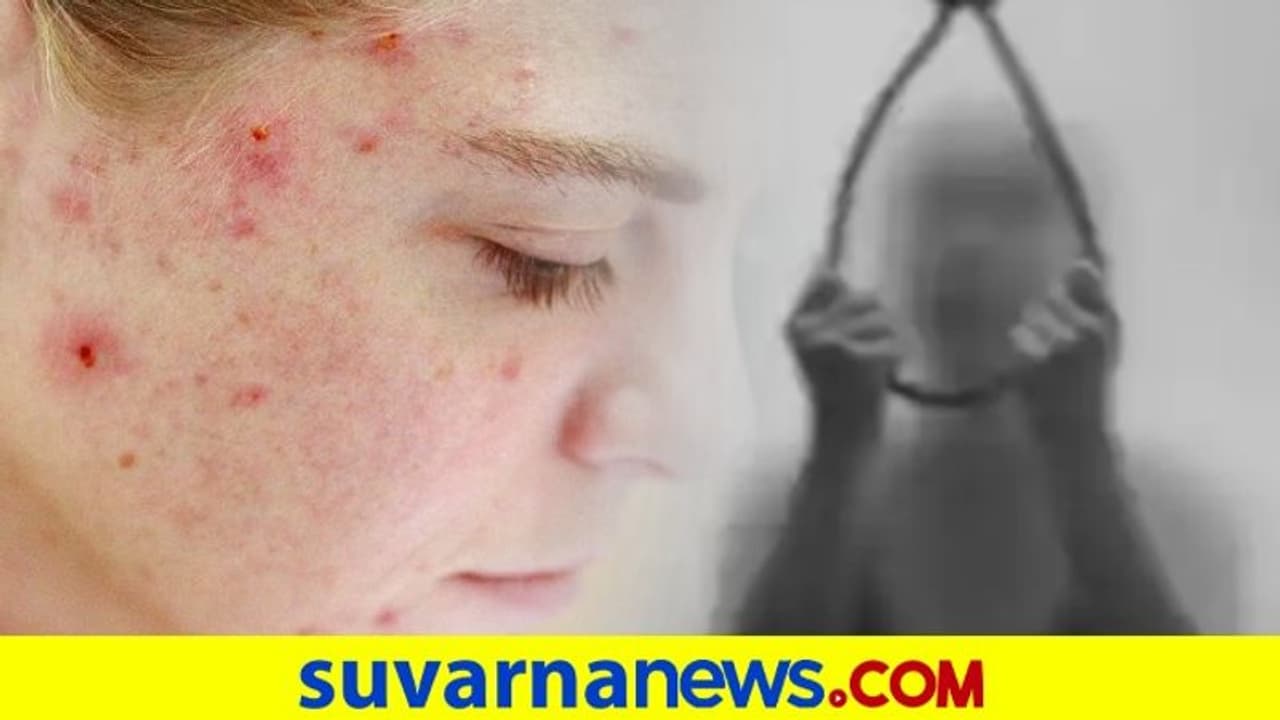 ಮೊಡವೆ ಹೆಚ್ಚಾಯ್ತೆಂದು ನೊಂದು ವಿದ್ಯಾರ್ಥಿನಿ ಆತ್ಮಹತ್ಯೆ ಮೊಡವೆ ಹೆಚ್ಚಾಯ್ತೆಂದು ನೊಂದು ವಿದ್ಯಾರ್ಥಿನಿ ಆತ್ಮಹತ್ಯೆ