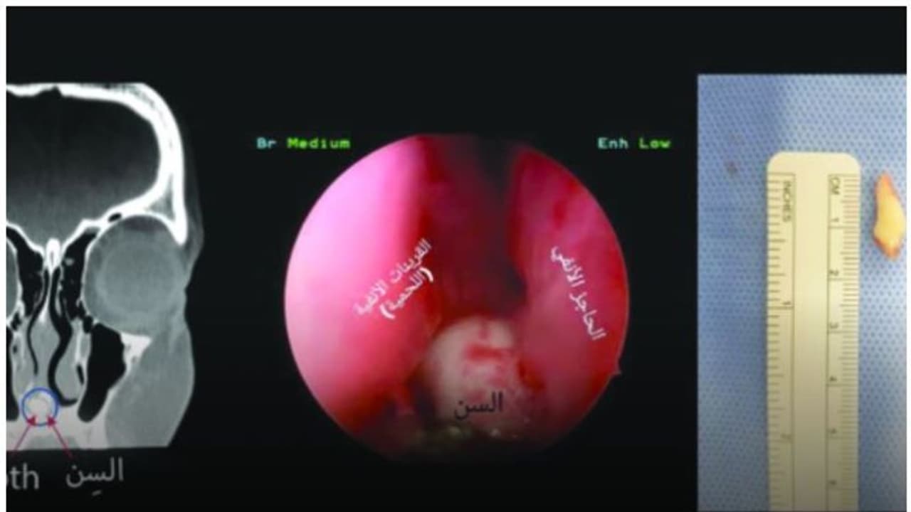 പതിനാറുകാരിയുടെ മൂക്കിനുള്ളില് എന്തോ തടയുന്നതായി തോന്നി; വിദഗ്ധ പരിശോധനയില് കണ്ടെത്തിയത്... പതിനാറുകാരിയുടെ മൂക്കിനുള്ളില് എന്തോ തടയുന്നതായി തോന്നി; വിദഗ്ധ പരിശോധനയില് കണ്ടെത്തിയത്...