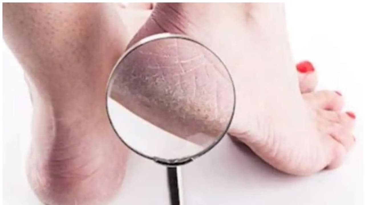 പാദങ്ങളിലെ വിണ്ടുകീറല് മാറാൻ രണ്ടുണ്ട് വഴി പാദങ്ങളിലെ വിണ്ടുകീറല് മാറാൻ രണ്ടുണ്ട് വഴി