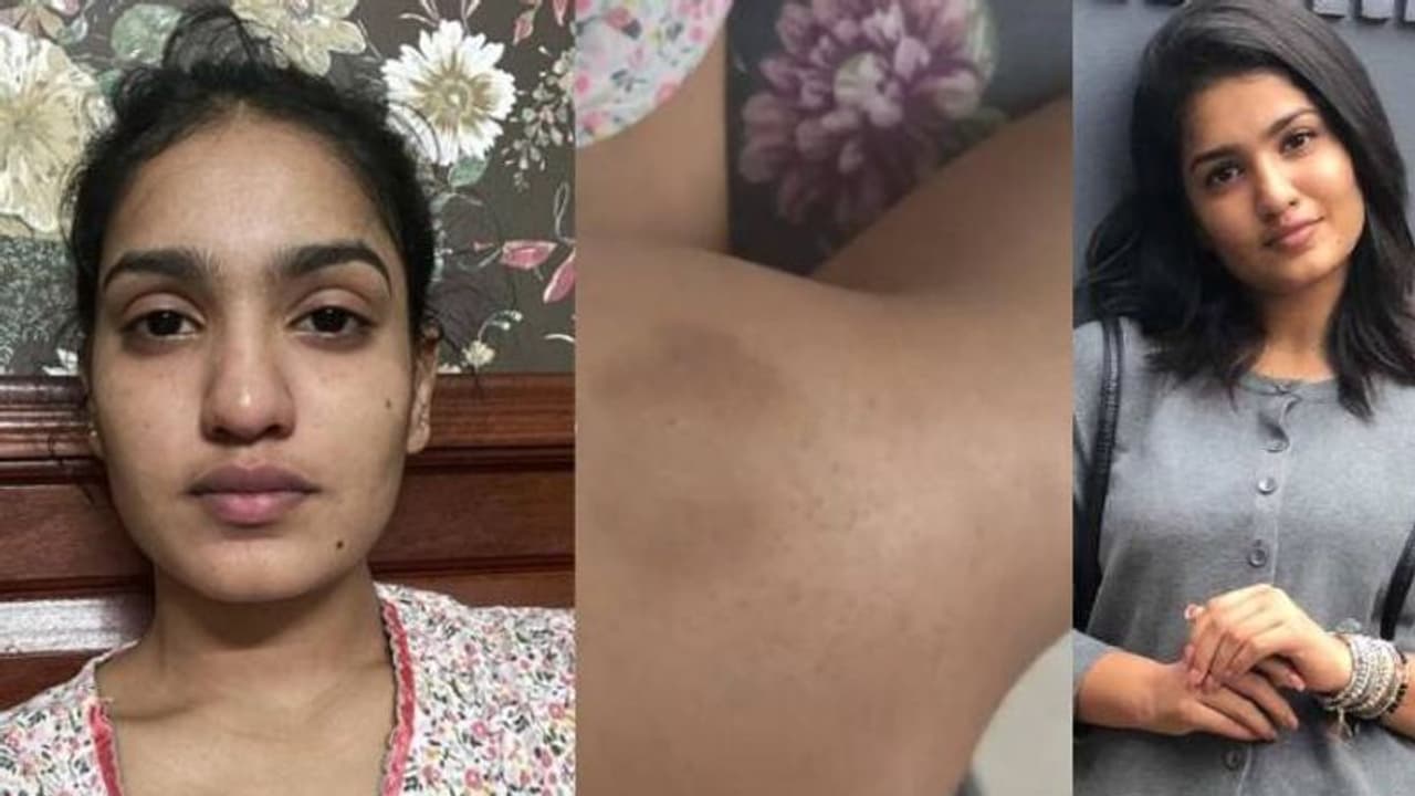 'ഇടത് കണ്ണിലെ കാഴ്ച മങ്ങാൻ തുടങ്ങി'; കൊവിഡ് അനുഭവം പങ്കുവച്ച് സാനിയ ഇയ്യപ്പൻ