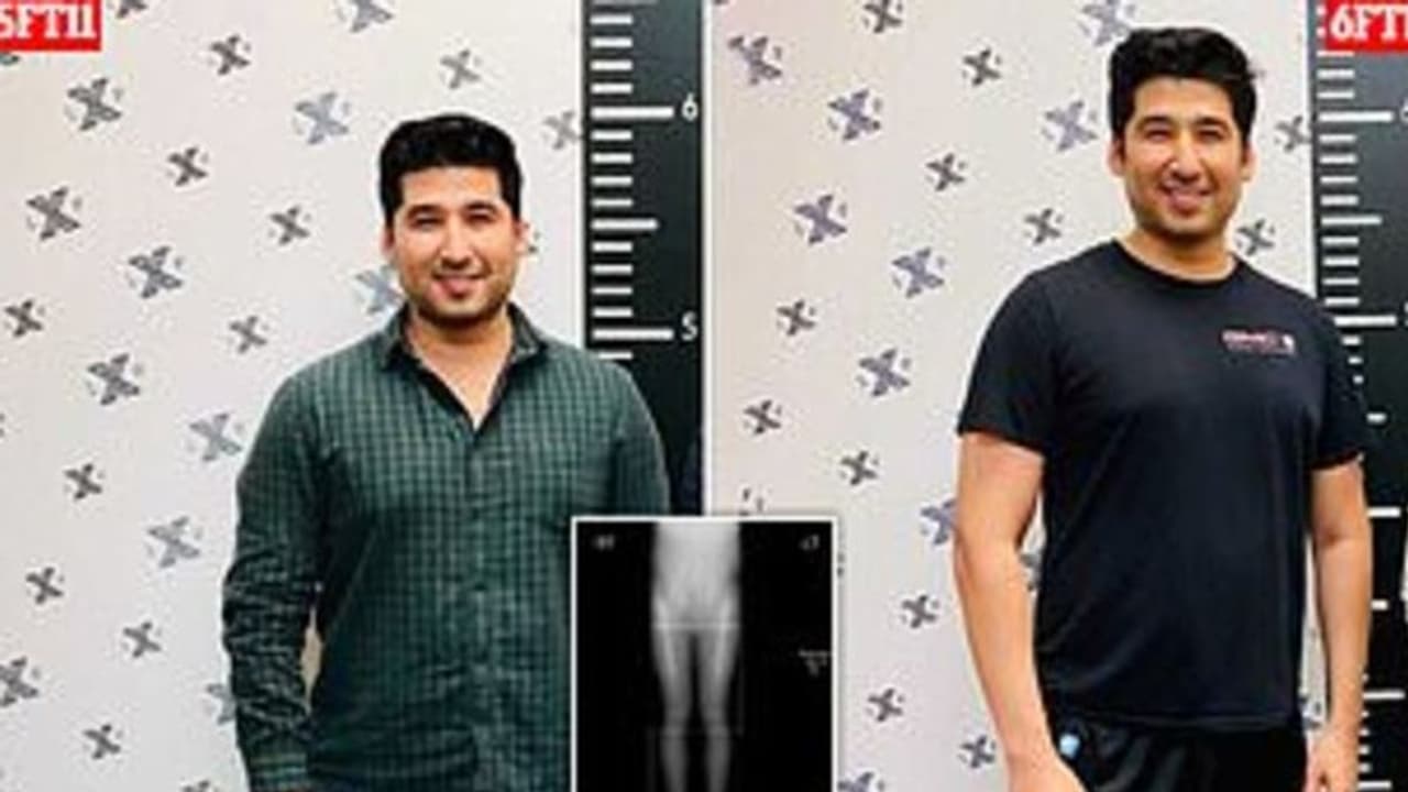 സങ്കല്‍പത്തിലെ 'ഹീറോ'യാകാന്‍ ഉയരം കൂട്ടൂന്ന ശസ്ത്രക്രിയയ്ക്ക് വിധേയനായി യുവാവ്