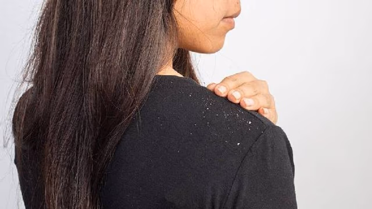 താരന് ശല്യമുണ്ടോ? ഇഞ്ചി കൊണ്ടൊരു പ്രതിവിധിയുണ്ട്! താരന് ശല്യമുണ്ടോ? ഇഞ്ചി കൊണ്ടൊരു പ്രതിവിധിയുണ്ട്!