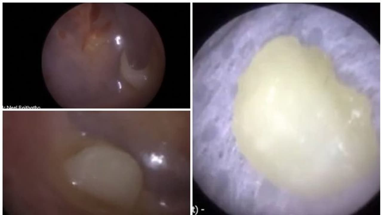രൂക്ഷമായ ചെവിവേദന; മൂന്നുവയസുകാരന്‍റെ ചെവിയില്‍ നിന്ന് പുറത്തുവന്ന വസ്തു കണ്ട് അമ്പരന്ന് ഡോക്ടര്‍