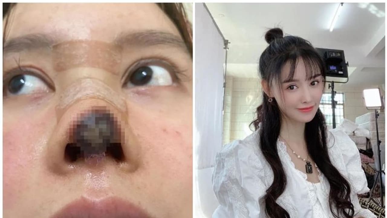 മൂക്കിന് ഭംഗി കൂട്ടാൻ വേണ്ടി കോസ്മറ്റിക് സർജറി ചെയ്തു, പിന്നീട് സംഭവിച്ചത്... മൂക്കിന് ഭംഗി കൂട്ടാൻ വേണ്ടി കോസ്മറ്റിക് സർജറി ചെയ്തു, പിന്നീട് സംഭവിച്ചത്...