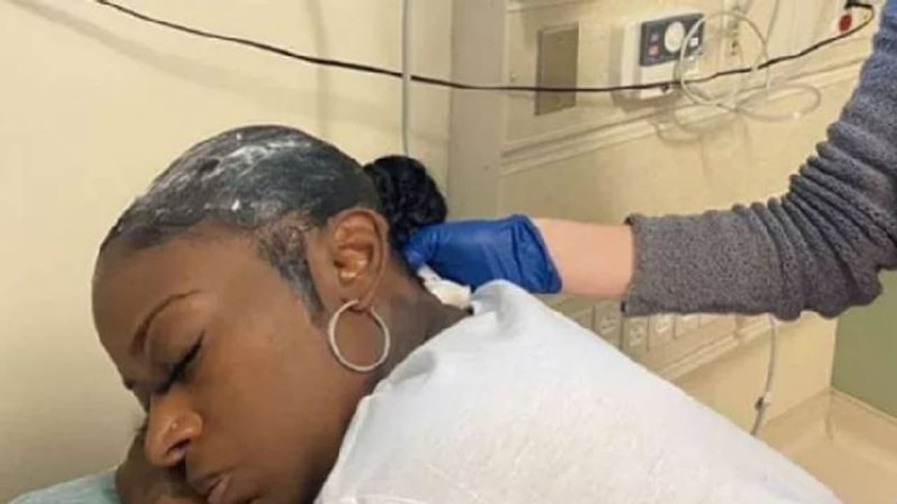 ഹെയർ സ്പ്രേക്ക് പകരം ഉപയോഗിച്ചത് പശ; ഒരു മാസമായി ഒട്ടിപ്പിടിച്ച തലമുടിയുമായി യുവതി