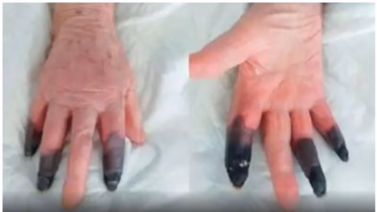 കൊവിഡ് ബാധിച്ച 86കാരിയുടെ വിരലുകള്‍ക്ക് കറുത്ത നിറം; മുറിച്ച് മാറ്റി ഡോക്ടര്‍മാര്‍