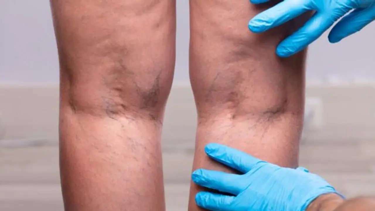 varicose veins