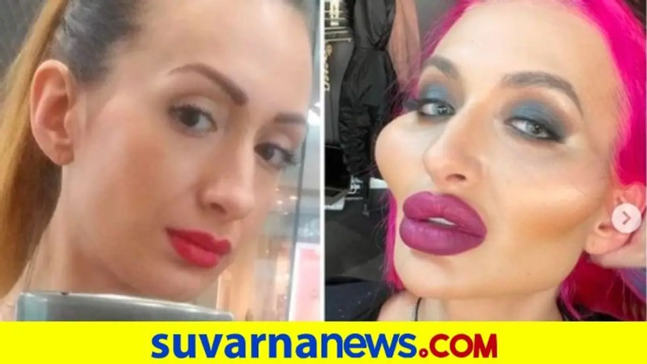 ವಿಶ್ವದಲ್ಲೇ ದೊಡ್ಡ ಕೆನ್ನೆಯ ಈ ಮಾಡೆಲ್‌ ಸರ್ಜರಿ ಮೊದಲು ಹೀಗಿದ್ಲು!