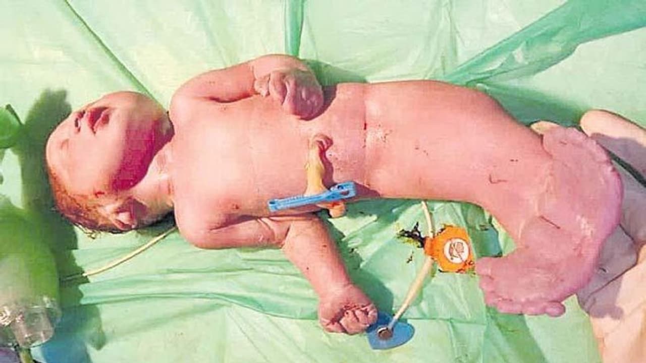 చేప ఆకారంలో శిశువు జననం... పుట్టిన కాసేపటికే..