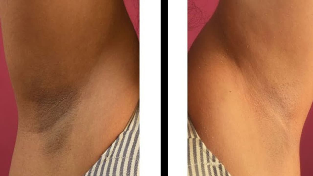 அக்குள் கருப்பா அசிங்கமா இருக்கா.. தயிர் மட்டும் போதும்.. வெறும் 5 நிமிடங்களில் மாறும் அதிசயம் 