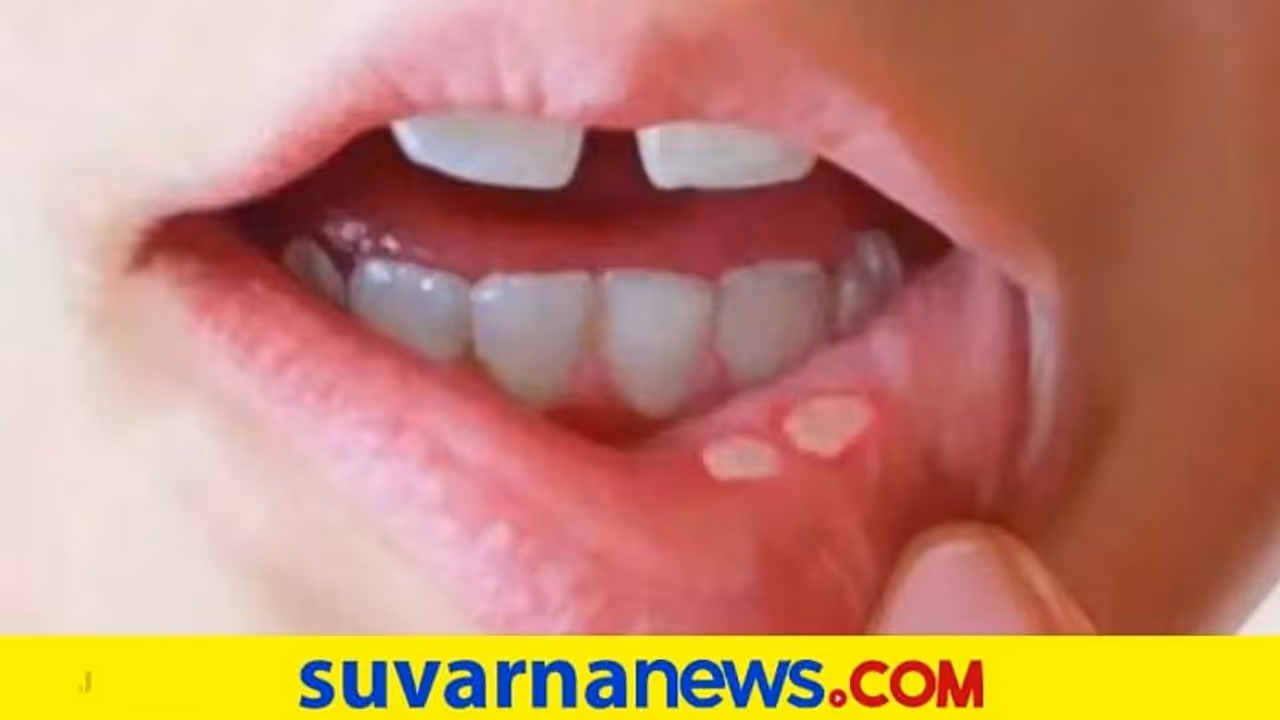 ಬಾಯಿ ಹುಣ್ಣಿಗೆ ಬೈ ಬೈ ಹೇಳೋ ಮದ್ದುಗಳು ಇಲ್ಲಿವೆ ನೋಡಿ… ಬಾಯಿ ಹುಣ್ಣಿಗೆ ಬೈ ಬೈ ಹೇಳೋ ಮದ್ದುಗಳು ಇಲ್ಲಿವೆ ನೋಡಿ…