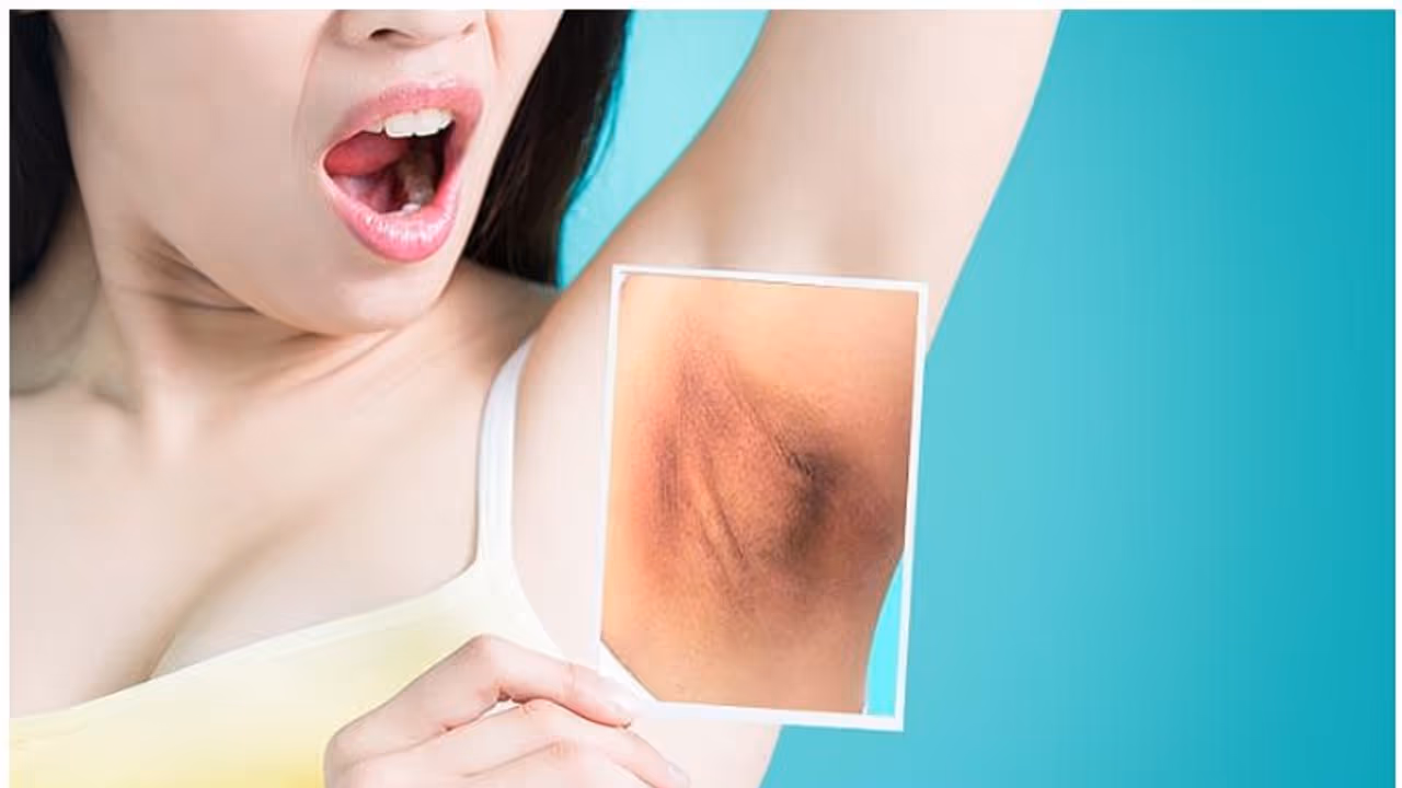 കക്ഷത്തിലെ കറുപ്പ് നിറം അകറ്റാൻ ഇതാ മൂന്ന് വഴികൾ