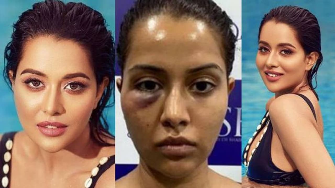 ത്വക്ക് ചികിത്സ പിഴച്ചു; നീരു വന്ന ചിത്രം പങ്കുവച്ച് നടി ത്വക്ക് ചികിത്സ പിഴച്ചു; നീരു വന്ന ചിത്രം പങ്കുവച്ച് നടി