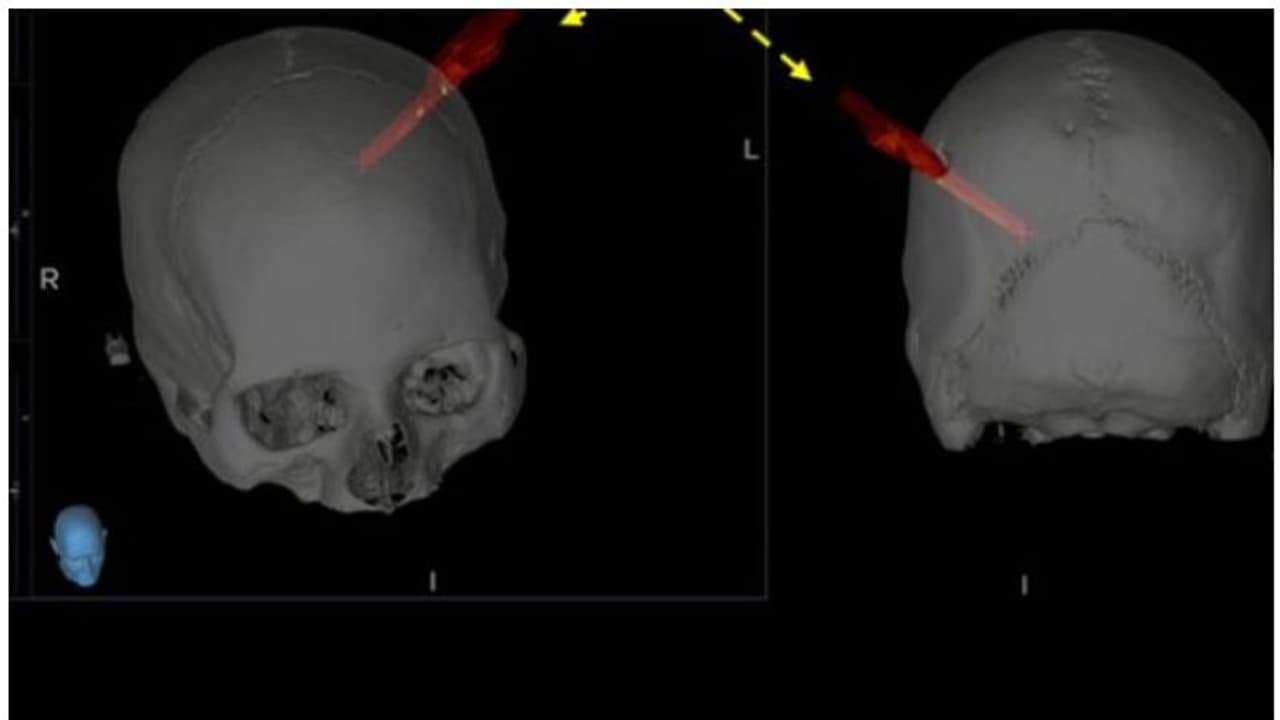 തലച്ചോറില്‍ മരക്കഷണം തുളച്ചുകയറി; യുവാവിന്‍റെ ജീവന്‍ രക്ഷിക്കാന്‍ മണിക്കൂറുകള്‍ നീണ്ട ശസ്ത്രക്രിയ
