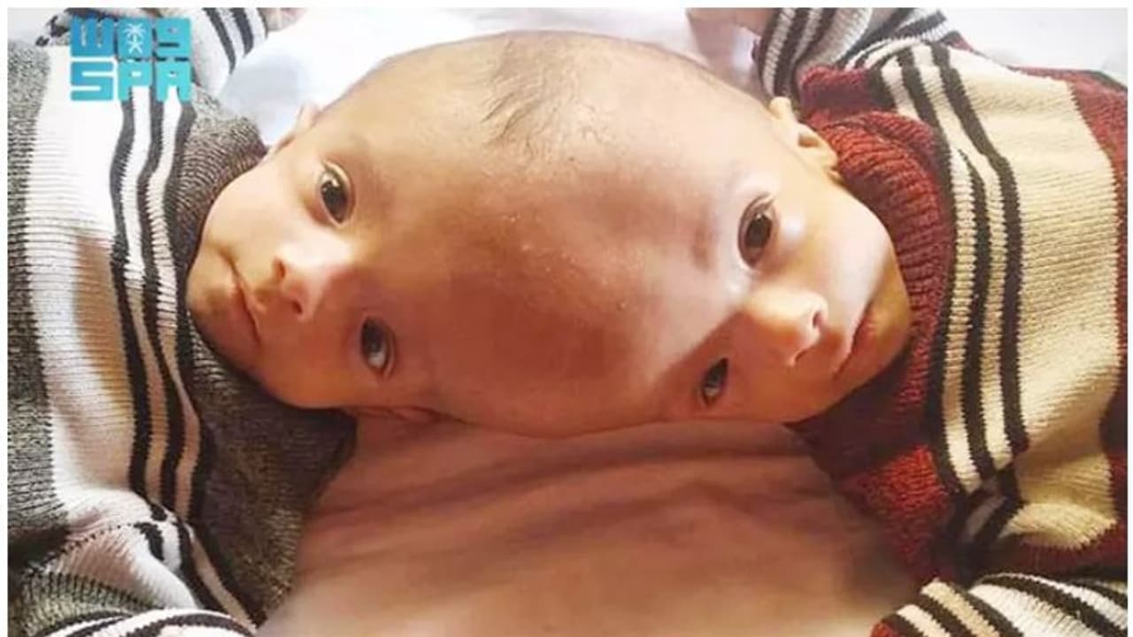 യെമനി സയാമീസ് ഇരട്ടകള്‍ക്ക് സൗദിയുടെ കാരുണ്യം