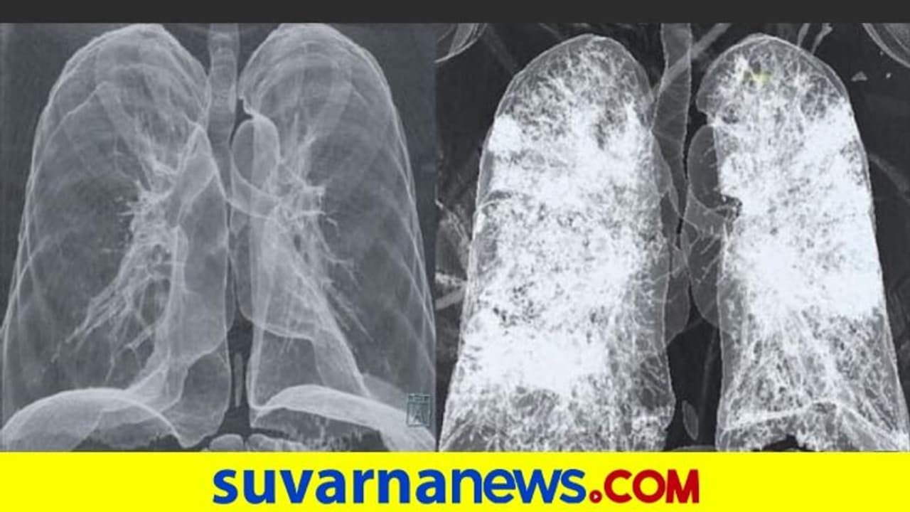 ಲಸಿಕೆ ಪಡೆಯೋದಾ? ಡೌಟ್‌ ಇರುವವರು ಈ ಫೋಟೋ ತಪ್ಪದೇ ನೋಡಿ: ಹೀಗಾಗುತ್ತೆ ಶ್ವಾಸಕೋಶ!