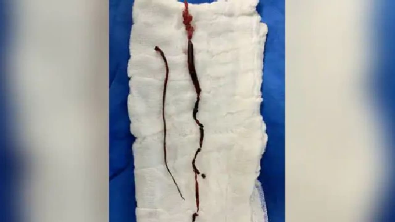 കൊവിഡ് രോഗികളില്‍ രക്തം കട്ട പിടിക്കുന്നതും ഹൃദയാഘാതം സംഭവിക്കുന്നതും; അറിയേണ്ട കാര്യങ്ങള്‍...