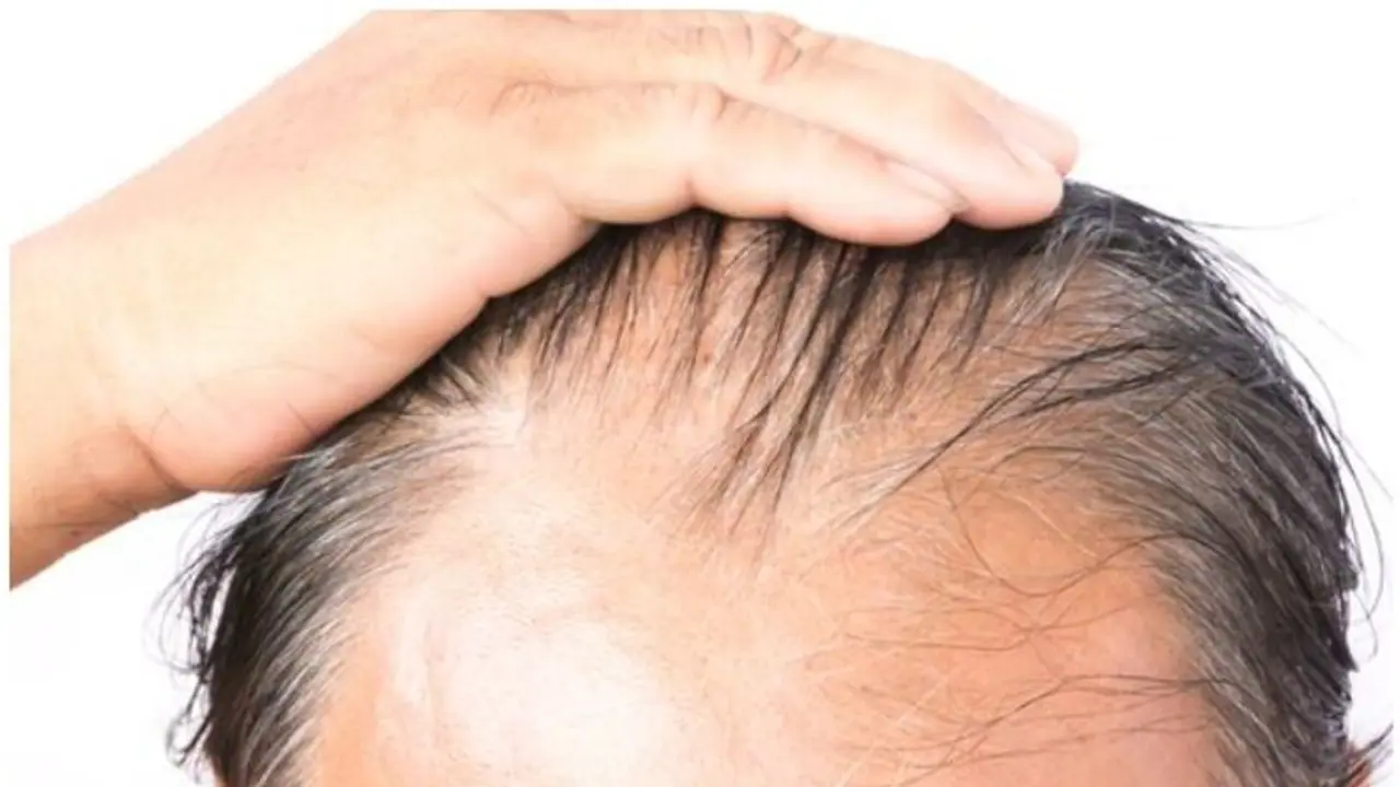 കൊവിഡ് 19; കഷണ്ടിയുള്ള പുരുഷന്മാരുടെ ശ്രദ്ധയ്ക്ക്; പഠനം പറയുന്നത്