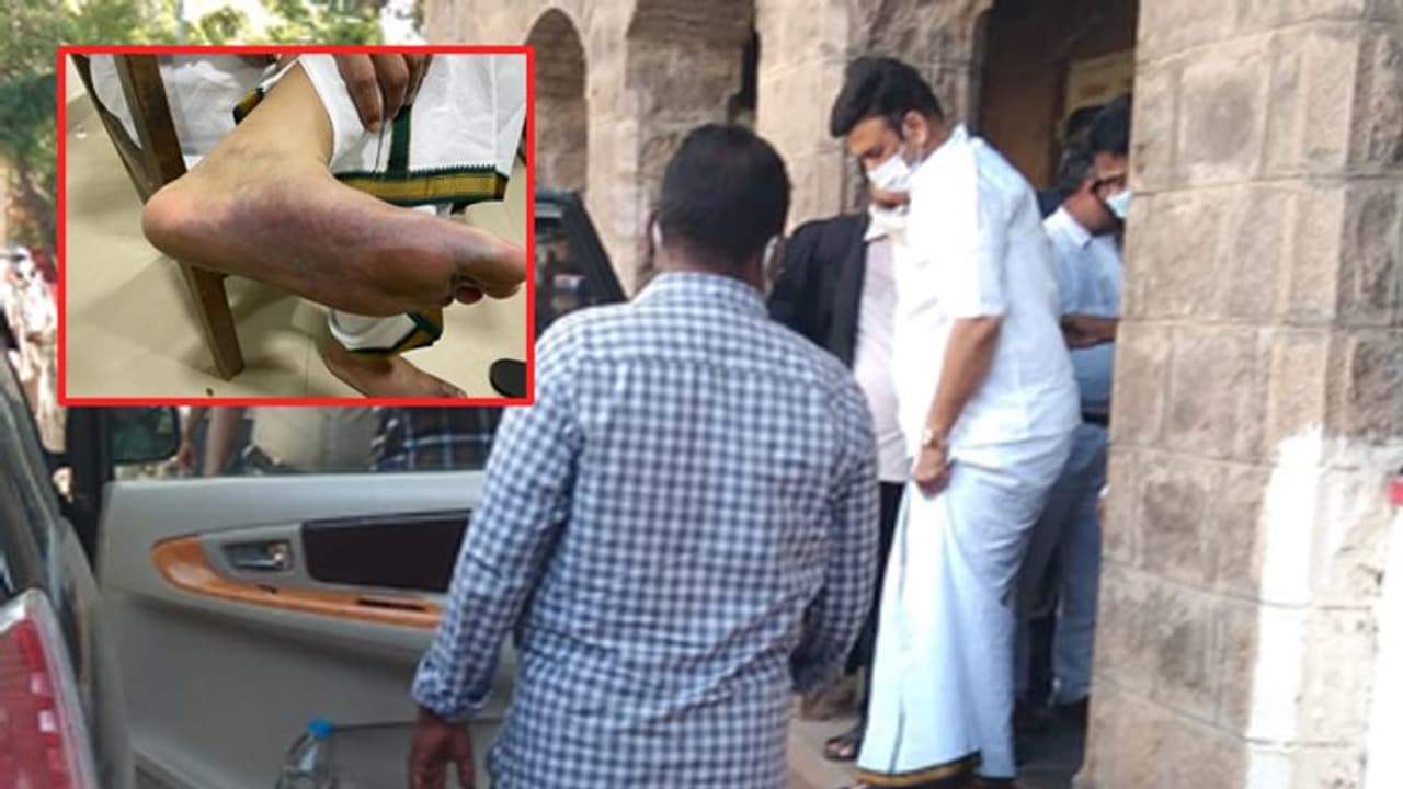 రఘురామ కాలికి గాయాలు: మీ వల్లేనని తేలితే.. పరిణామాలు తీవ్రంగా ఉంటాయి, సీఐడీపై హైకోర్టు ఆగ్రహం రఘురామ కాలికి గాయాలు: మీ వల్లేనని తేలితే.. పరిణామాలు తీవ్రంగా ఉంటాయి, సీఐడీపై హైకోర్టు ఆగ్రహం