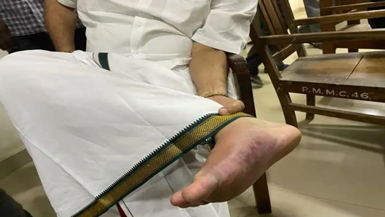 రఘురామ కృష్ణమ రాజు అరికాళ్లు కమిలినట్లు ఎందుకున్నాయంటే... రఘురామ కృష్ణమ రాజు అరికాళ్లు కమిలినట్లు ఎందుకున్నాయంటే...