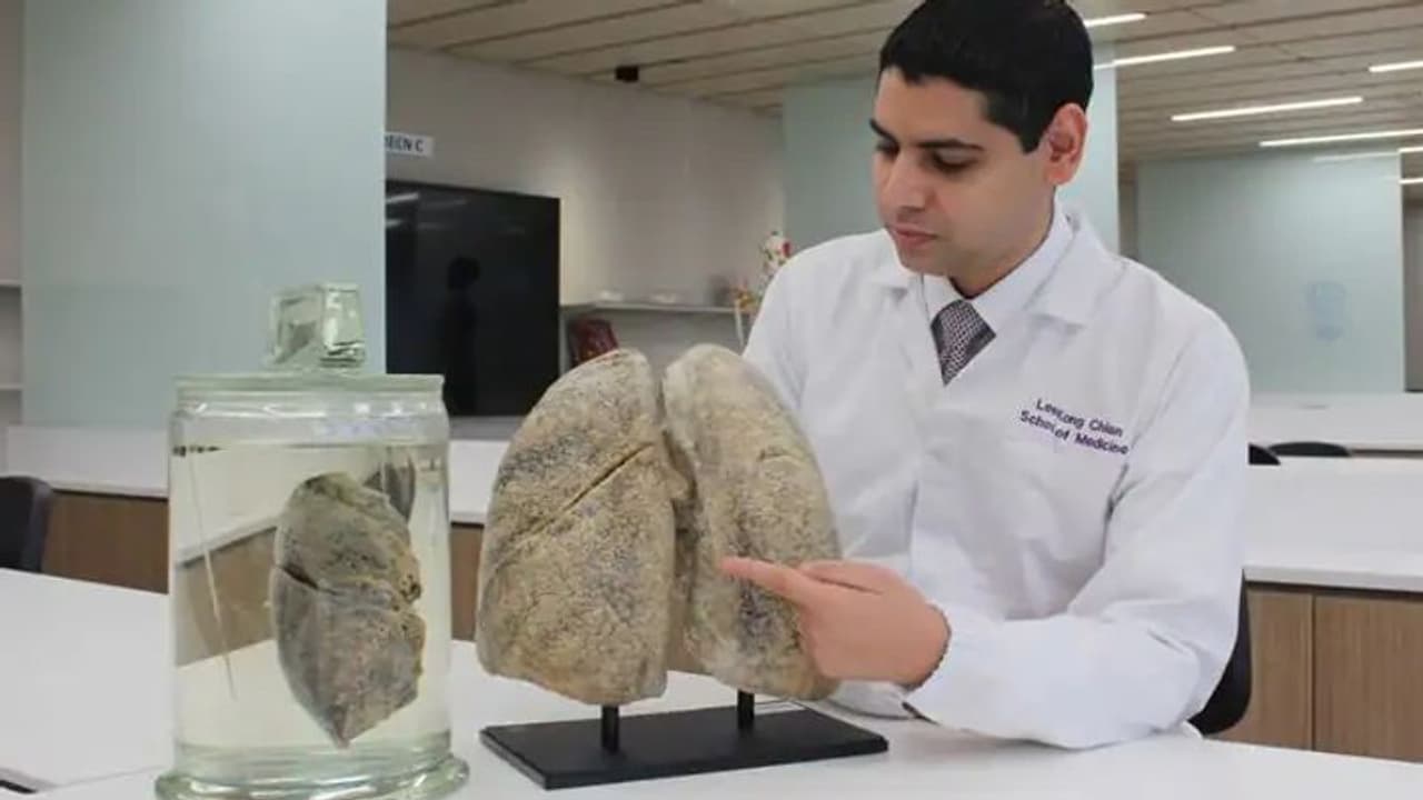 బ్యాక్టీరియా, వైరస్, శిలీంధ్రాల నెట్‌వర్క్‌ వల్లే.... ఊపిరితిత్తల ఇన్‌ఫెక్షన్‌: సింగపూర్ ఎన్టీయూ అధ్యయనం