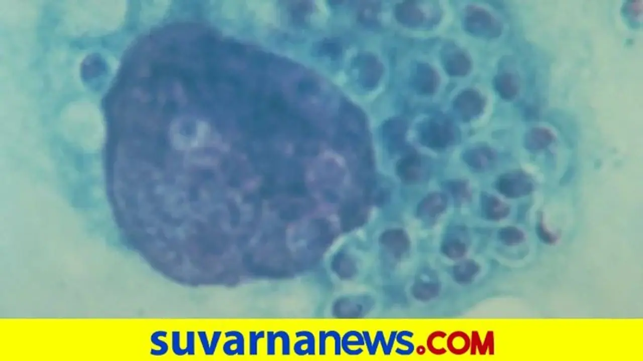 ಗುಪ್ತಾಂಗ, ಚರ್ಮ, ಮೆದುಳಿಗೆ ಹಾನಿ, ಬ್ಲ್ಯಾಕ್ ಫಂಗಸ್‌ಗಿಂತಲೂ ಡೇಂಜರ್ ಈ ವೈಟ್‌ ಫಂಗಸ್!