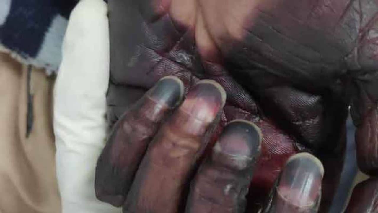 ಬ್ಲ್ಯಾಕ್ ಫಂಗಸ್ ಭಾರೀ ಏರಿಕೆ: 3 ವಾರದಲ್ಲಿ 2,100 ಬಲಿ! ಬ್ಲ್ಯಾಕ್ ಫಂಗಸ್ ಭಾರೀ ಏರಿಕೆ: 3 ವಾರದಲ್ಲಿ 2,100 ಬಲಿ!