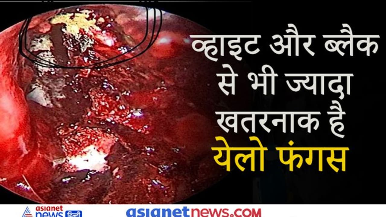 यूपी के गाजियाबाद में एक मरीज में मिला पहला येलो फंगस, जानिए ब्लैक या व्हाइट फंगस से कितना अलग है यह यूपी के गाजियाबाद में एक मरीज में मिला पहला येलो फंगस, जानिए ब्लैक या व्हाइट फंगस से कितना अलग है यह