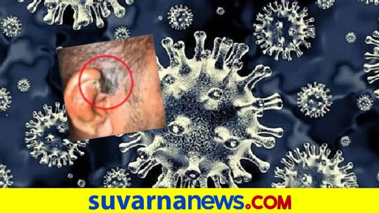 ಚಿತ್ರದುರ್ಗ ಕೋವಿಡ್‌ ರೋಗಿ ಚರ್ಮಕ್ಕೆ ಬ್ಲ್ಯಾಕ್‌ ಫಂಗಸ್‌: ದೇಶದಲ್ಲೇ ಮೊದಲು!
