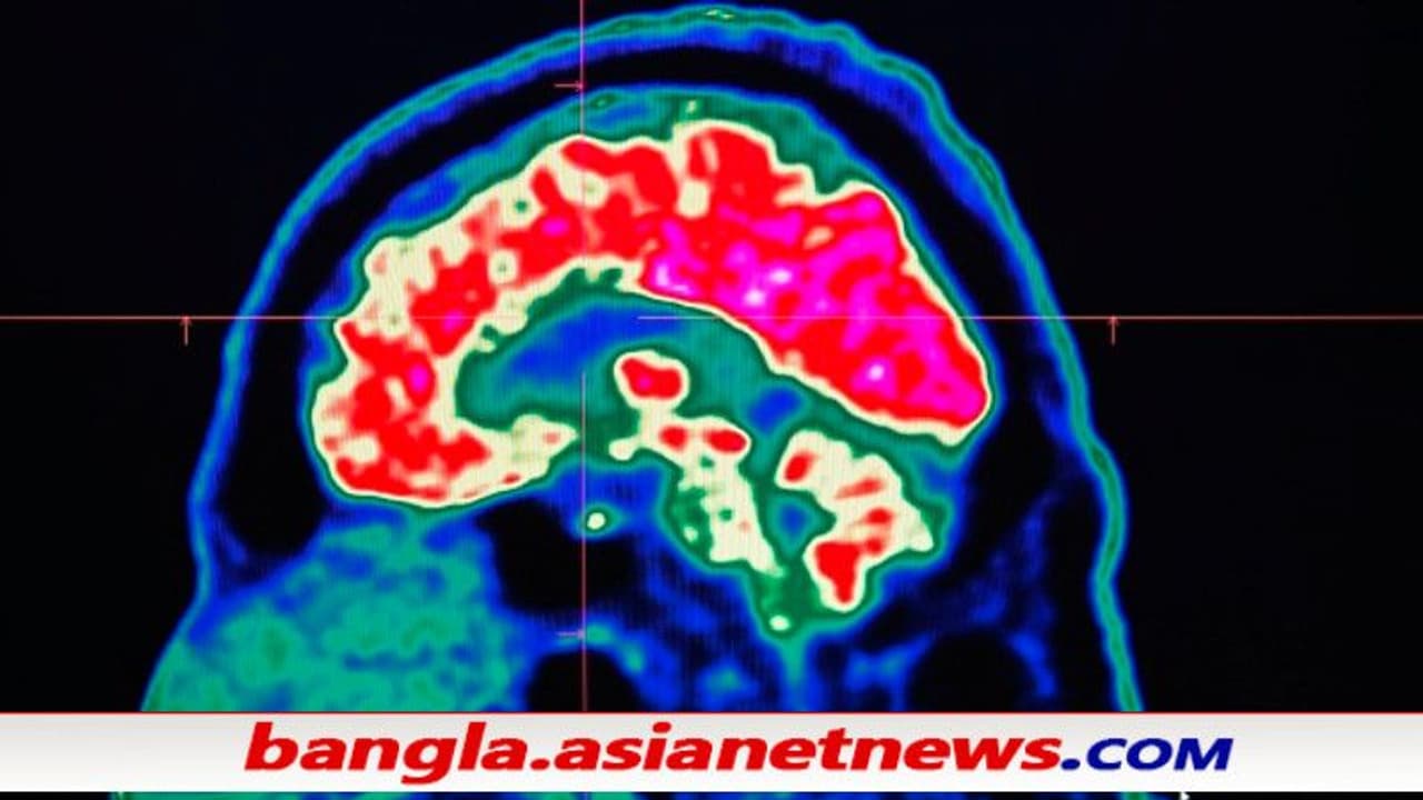 আক্রান্তরা দেখতে পাচ্ছেন মৃতদের, করোনার মধ্যেই রহস্যময় মস্তিষ্কের রোগ টিকাই কি দায়ী আক্রান্তরা দেখতে পাচ্ছেন মৃতদের, করোনার মধ্যেই রহস্যময় মস্তিষ্কের রোগ টিকাই কি দায়ী