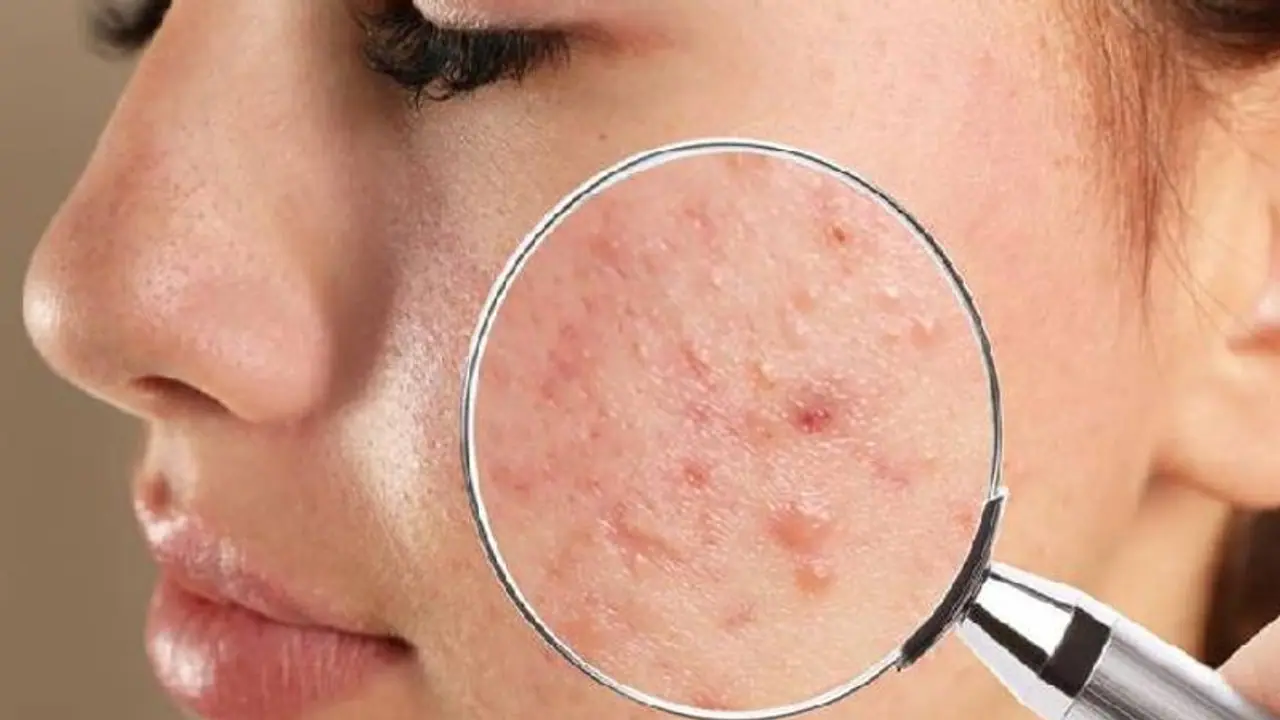 മുഖക്കുരു മാറാന് വീട്ടില് പരീക്ഷിക്കാം ഈ നാടൻ വഴികള്... മുഖക്കുരു മാറാന് വീട്ടില് പരീക്ഷിക്കാം ഈ നാടൻ വഴികള്...