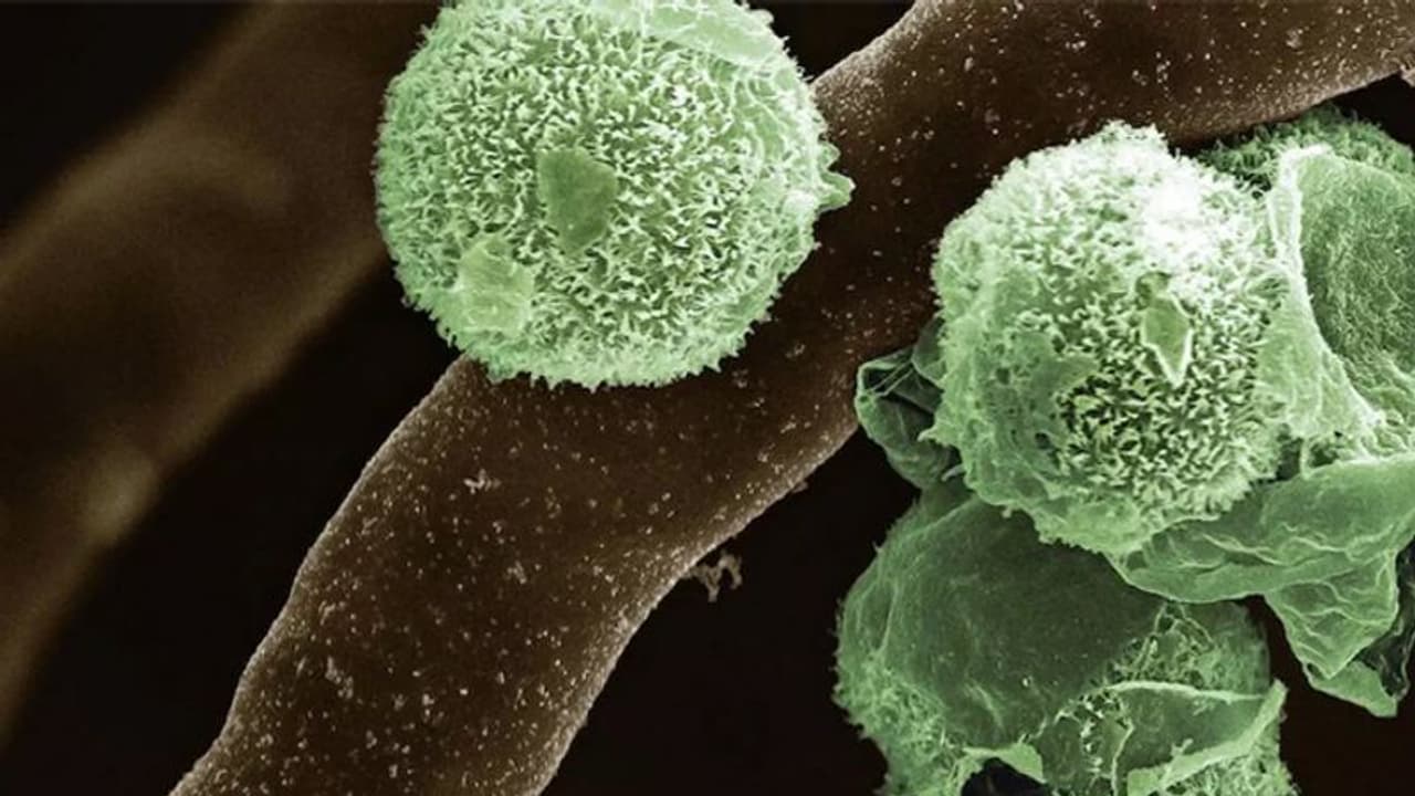 భారత్లో కొత్తగా గ్రీన్ ఫంగస్.. మధ్యప్రదేశ్లో తొలి కేసు: ఊపిరితిత్తులు, రక్తం, సైనస్లపై తీవ్ర ప్రభావం భారత్లో కొత్తగా గ్రీన్ ఫంగస్.. మధ్యప్రదేశ్లో తొలి కేసు: ఊపిరితిత్తులు, రక్తం, సైనస్లపై తీవ్ర ప్రభావం