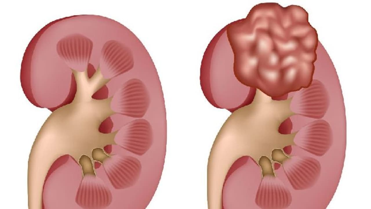 കൊവിഡ് 19 വൃക്കയെയും തകരാറിലാക്കാമെന്ന് പുതിയ പഠനം കൊവിഡ് 19 വൃക്കയെയും തകരാറിലാക്കാമെന്ന് പുതിയ പഠനം