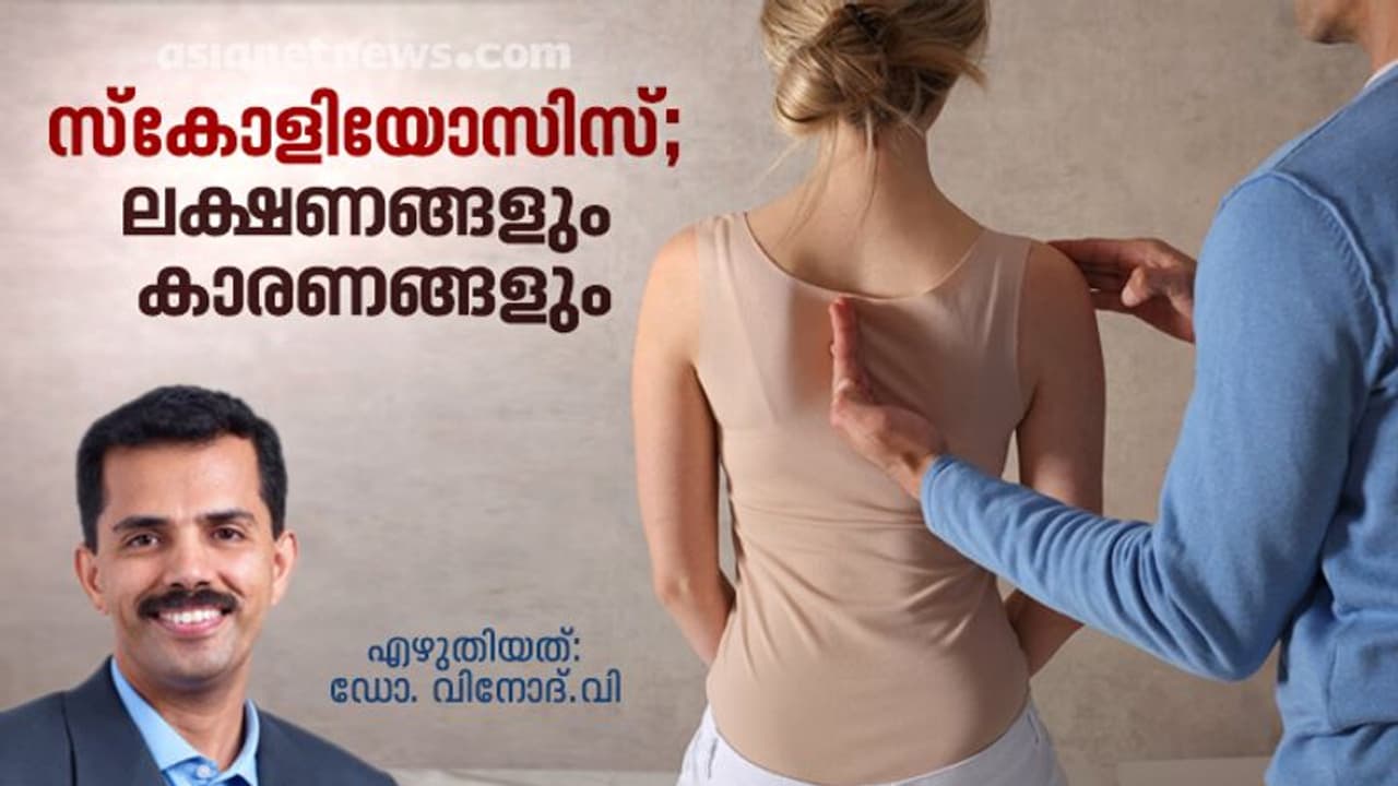 നേരത്തെയറിഞ്ഞാല് സ്കോളിയോസിസിനെ ഭയപ്പെടേണ്ട; ഡോക്ടർ എഴുതിയത് നേരത്തെയറിഞ്ഞാല് സ്കോളിയോസിസിനെ ഭയപ്പെടേണ്ട; ഡോക്ടർ എഴുതിയത്