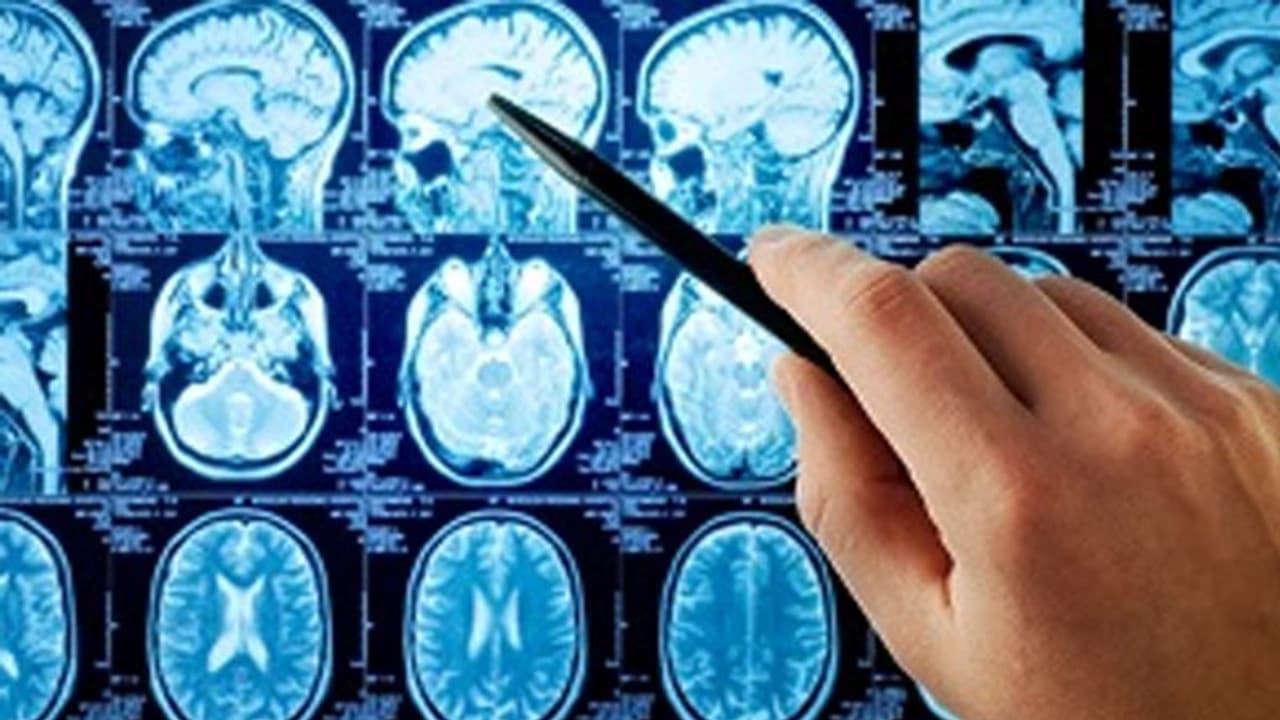 कोरोना से ठीक हुई महिला को ब्रेन हैमरेज, सिर में 3x4 सेमी साइज का ब्लड क्लॉट था कोरोना से ठीक हुई महिला को ब्रेन हैमरेज, सिर में 3x4 सेमी साइज का ब्लड क्लॉट था