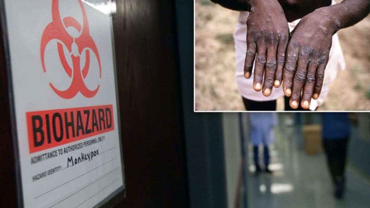 क्या है 'मंकीपॉक्स' संक्रमण, जिसने 20 साल में पहली बार अमेरिका में दी दस्तक, टेक्सास में मिला मरीज क्या है 'मंकीपॉक्स' संक्रमण, जिसने 20 साल में पहली बार अमेरिका में दी दस्तक, टेक्सास में मिला मरीज
