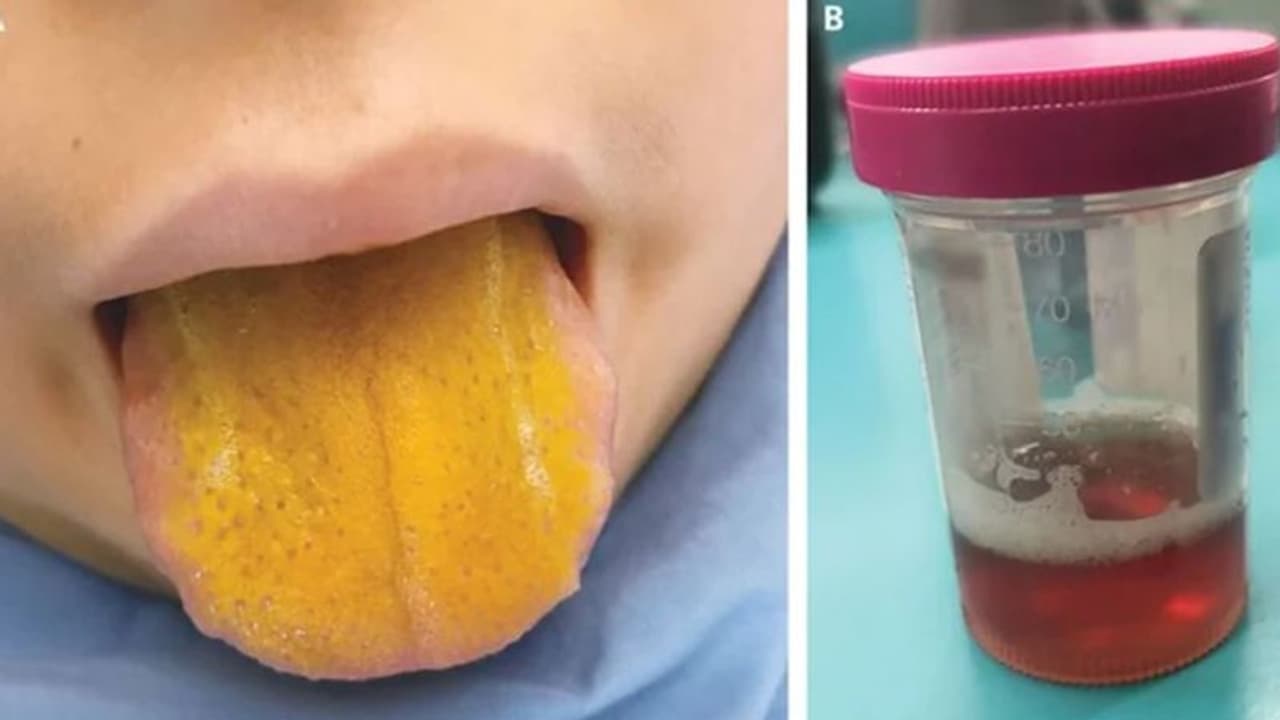 ಕೊರೋನಾ ಮಧ್ಯೆ ಹೊಸ ರೋಗ, ನಾಲಗೆ ಬಣ್ಣ ಹಳದಿ! ಕೊರೋನಾ ಮಧ್ಯೆ ಹೊಸ ರೋಗ, ನಾಲಗೆ ಬಣ್ಣ ಹಳದಿ!