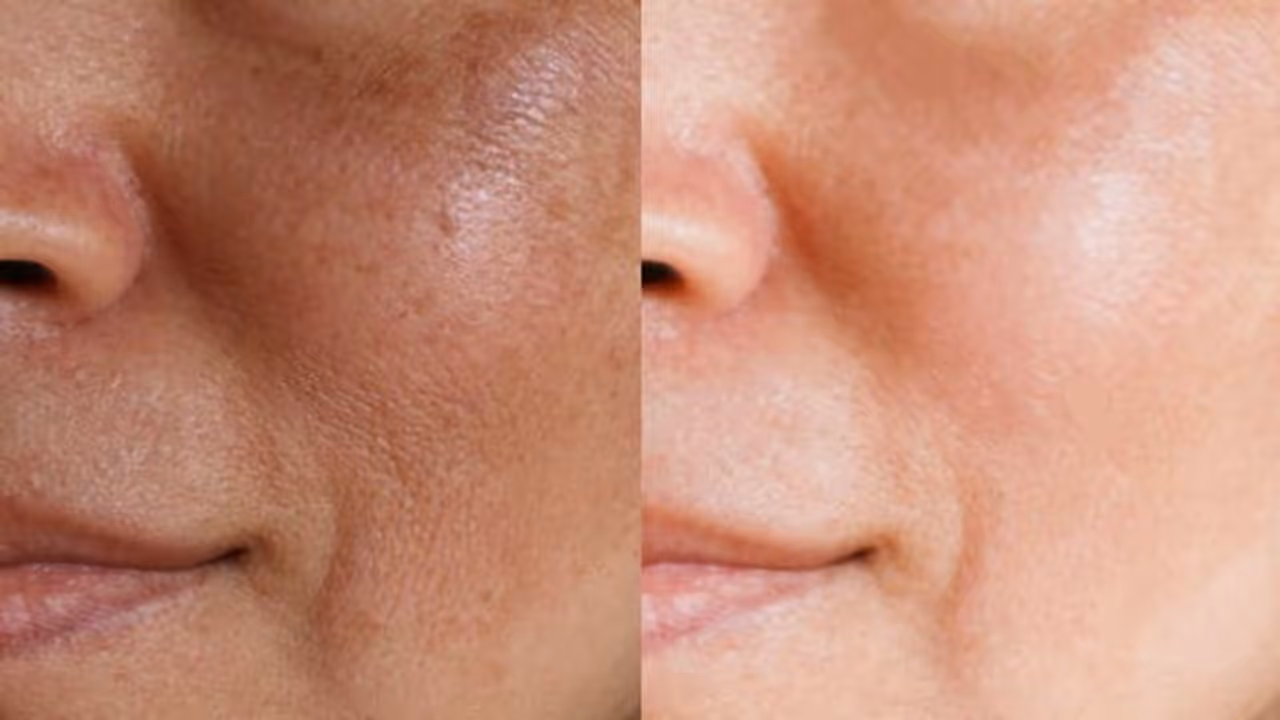 മുഖത്തെ കുഴികൾ മാറാന് പരീക്ഷിക്കാം ഈ ആറ് വഴികള്... മുഖത്തെ കുഴികൾ മാറാന് പരീക്ഷിക്കാം ഈ ആറ് വഴികള്...