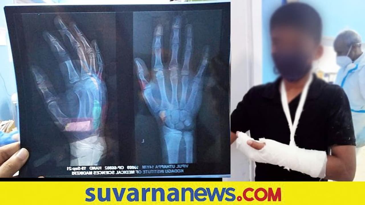 ಕ್ರೀಡಾ ವಸತಿ ನಿಲಯದಲ್ಲಿ ವಿದ್ಯಾರ್ಥಿಯ ಕೈ ಮುರಿತ : ಕೋಚ್ ವಿರುದ್ದ ಆರೋಪ