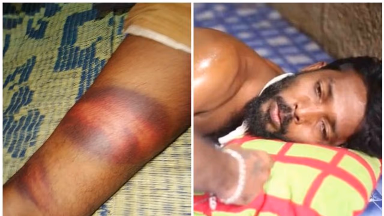 ബൈക്ക് നിര്ത്തി മൂത്രം ഒഴിക്കാൻ ഇറങ്ങിയ രോഗിയായ യുവാവിന് പൊലീസ് ക്രൂരമായി മര്ദ്ദിച്ചതായി ആരോപണം ബൈക്ക് നിര്ത്തി മൂത്രം ഒഴിക്കാൻ ഇറങ്ങിയ രോഗിയായ യുവാവിന് പൊലീസ് ക്രൂരമായി മര്ദ്ദിച്ചതായി ആരോപണം