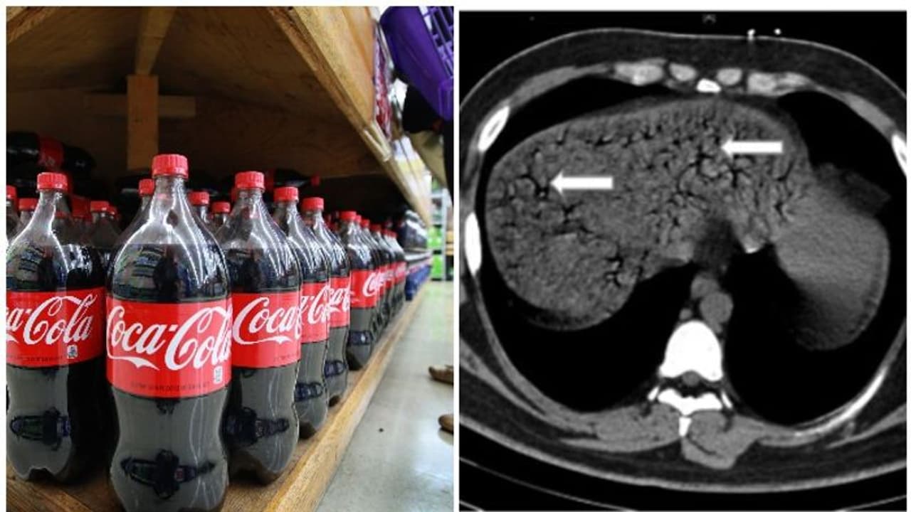 ഒന്നരലിറ്റർ കൊക്കക്കോള പത്തുമിനിട്ടിൽ കുടിച്ചിറക്കിയ ഇരുപത്തിരണ്ടുകാരന് ദാരുണാന്ത്യം എന്ന് ഡോക്ടർമാർ ഒന്നരലിറ്റർ കൊക്കക്കോള പത്തുമിനിട്ടിൽ കുടിച്ചിറക്കിയ ഇരുപത്തിരണ്ടുകാരന് ദാരുണാന്ത്യം എന്ന് ഡോക്ടർമാർ