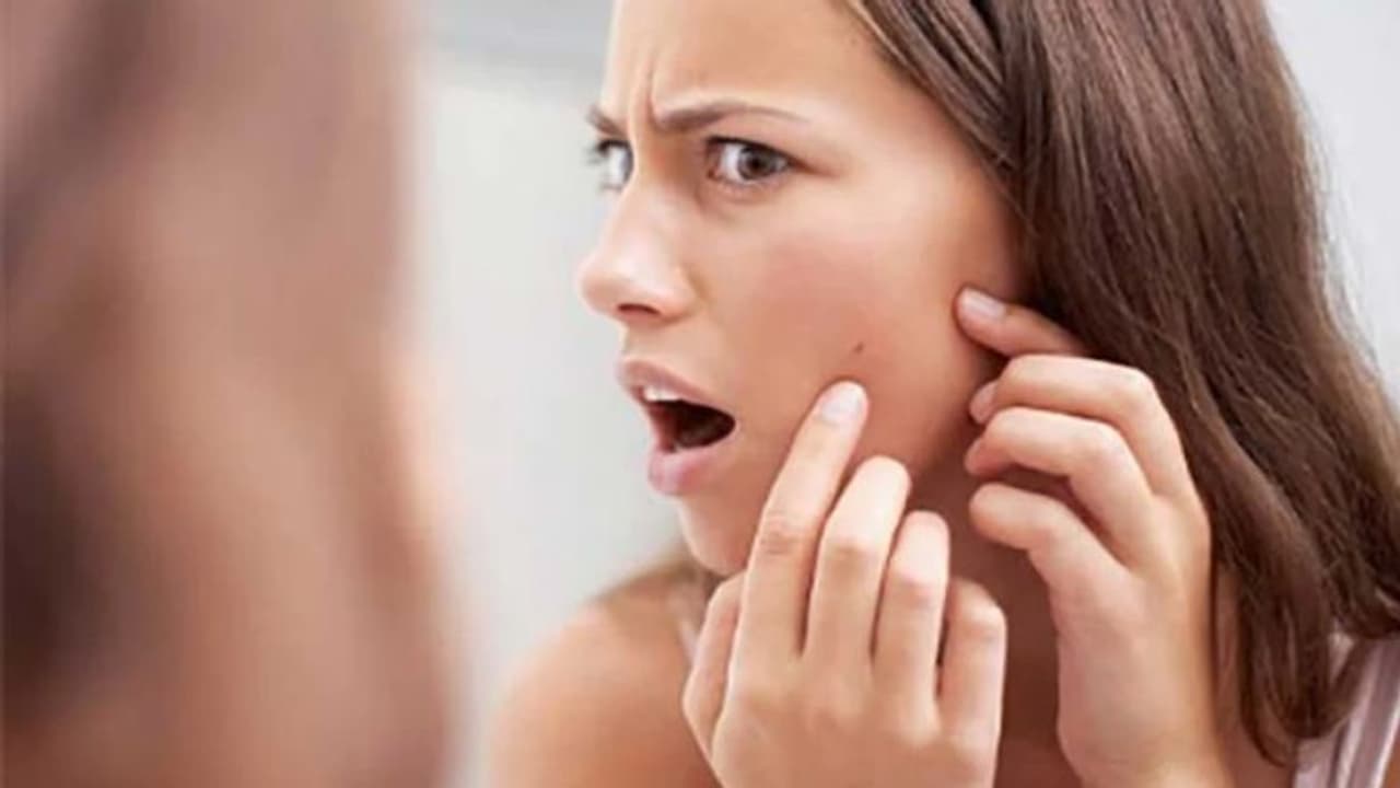 മുഖക്കുരുവിന്റെ കറുത്ത പാടുകള് അകറ്റാന് പരീക്ഷിക്കാം ഈ ഫേസ് പാക്കുകള്... മുഖക്കുരുവിന്റെ കറുത്ത പാടുകള് അകറ്റാന് പരീക്ഷിക്കാം ഈ ഫേസ് പാക്കുകള്...