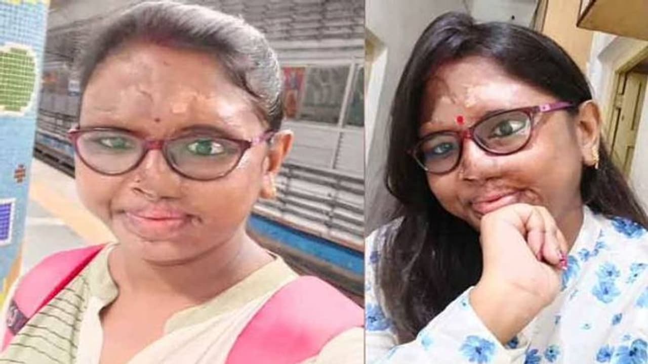 മുഖത്തേക്ക് ആസിഡൊഴിച്ചു, മുഖം പൊള്ളിയടർന്നു, എന്നാൽ ജീവിതത്തിൽ തോല്ക്കാതെ സഞ്ചയിത മുഖത്തേക്ക് ആസിഡൊഴിച്ചു, മുഖം പൊള്ളിയടർന്നു, എന്നാൽ ജീവിതത്തിൽ തോല്ക്കാതെ സഞ്ചയിത