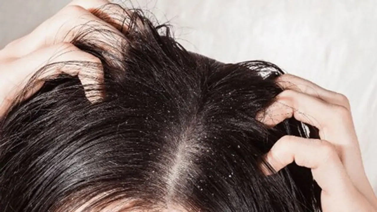 dandruff| താരൻ അകറ്റാൻ വീട്ടിലുണ്ട് മൂന്ന് പ്രതിവിധികൾ dandruff| താരൻ അകറ്റാൻ വീട്ടിലുണ്ട് മൂന്ന് പ്രതിവിധികൾ