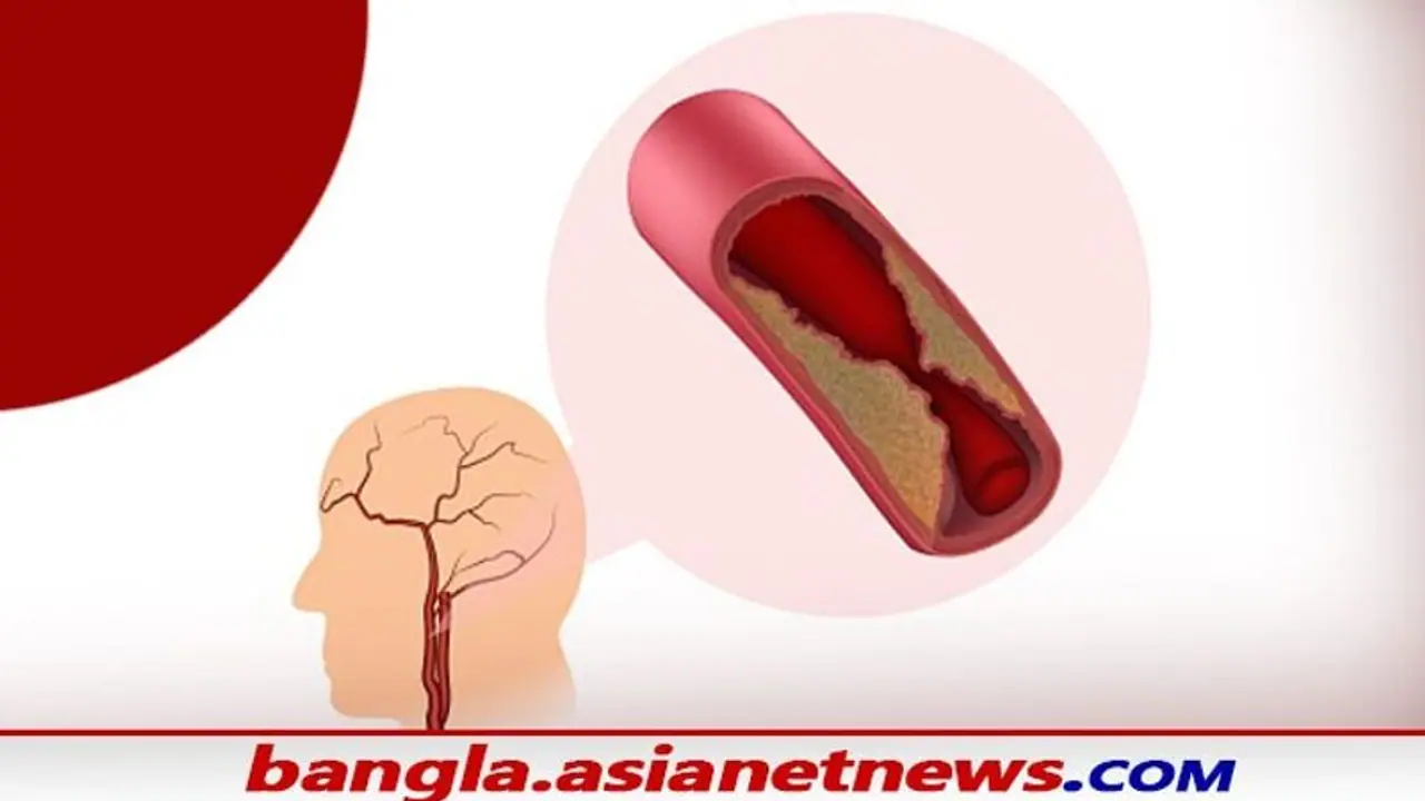 Health Tips: ক্যারোটিড আর্টারি ডিজিজে আক্রান্ত হচ্ছেন অনেকে, জেনে নিন এই রোগের ইতি বৃত্তান্ত Health Tips: ক্যারোটিড আর্টারি ডিজিজে আক্রান্ত হচ্ছেন অনেকে, জেনে নিন এই রোগের ইতি বৃত্তান্ত