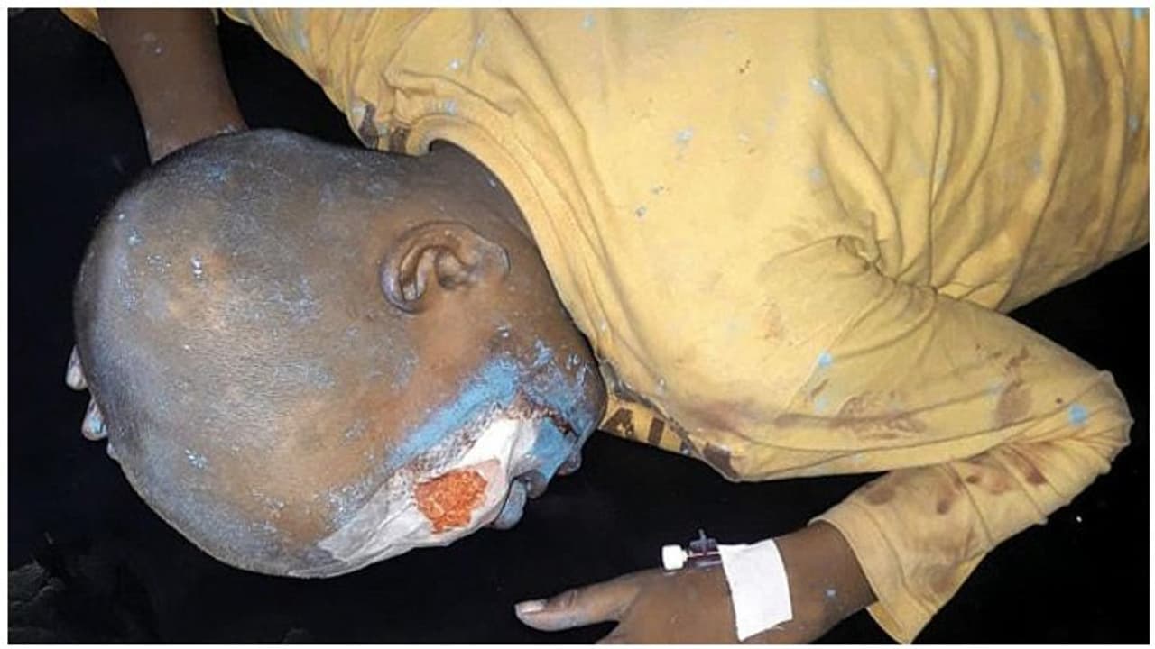 பட்டாசு வெடித்ததில் இடது கண்ணை இழந்த 11 வயது சிறுவன்... வேடிக்கை பார்த்தபோது நடந்த பரிதாபம்..! பட்டாசு வெடித்ததில் இடது கண்ணை இழந்த 11 வயது சிறுவன்... வேடிக்கை பார்த்தபோது நடந்த பரிதாபம்..!