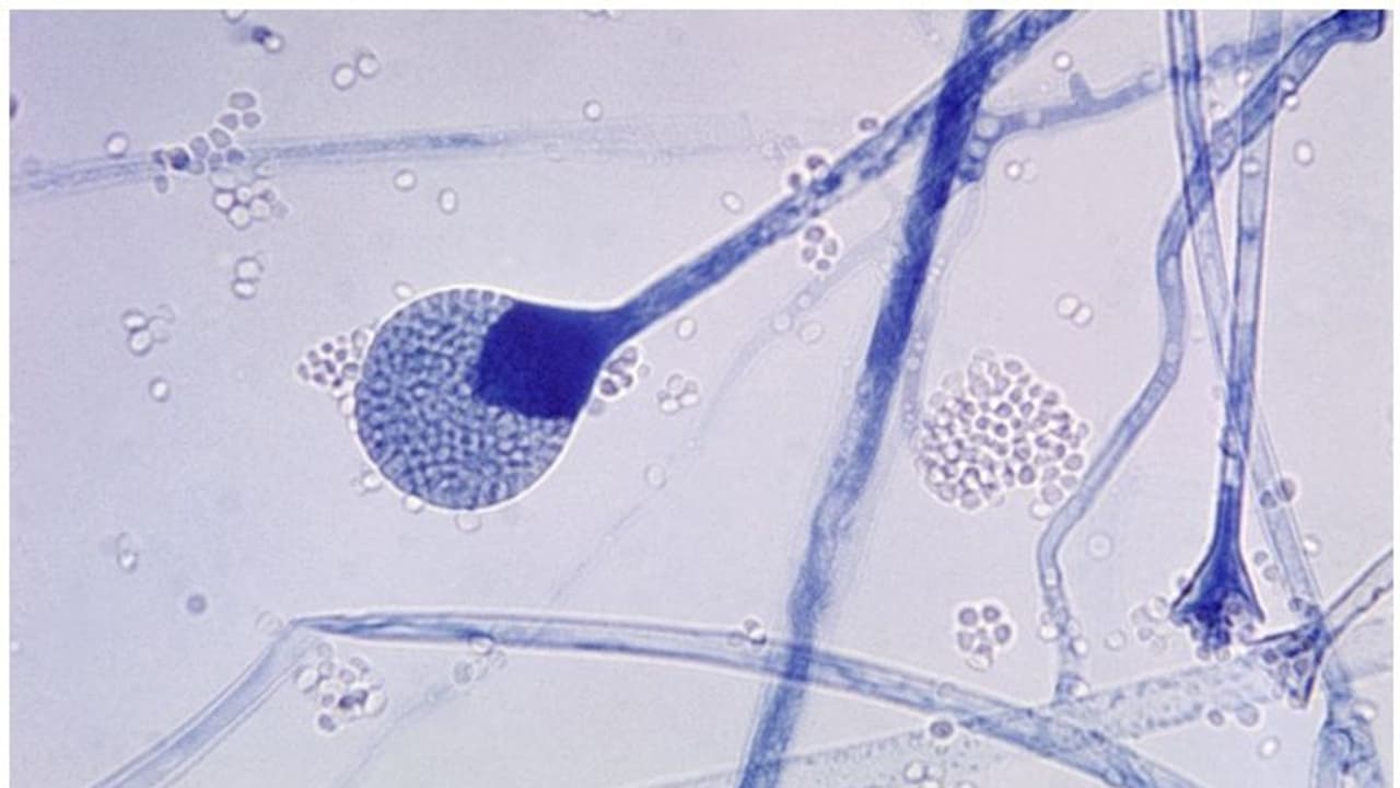 black fungus| ബ്ലാക്ക് ഫംഗസ് പ്രമേഹരോഗികളിൽ കൂടുതൽ: പഠനം